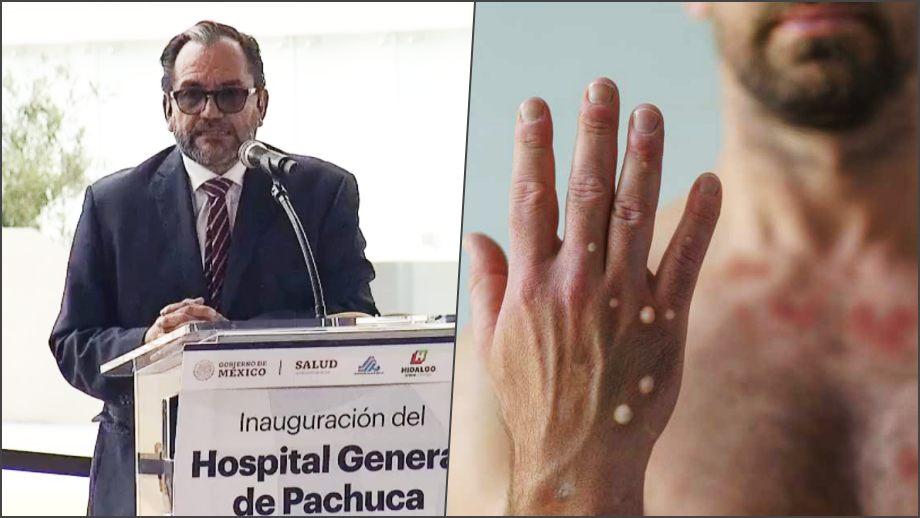SSH confirma llegada de viruela del mono a Hidalgo y advierte: "esto es una pandemia"