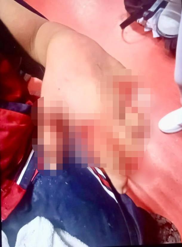 ¡Lamentable! Adolescente pierde dedos al explotarle pirotecnia; ocurrió en Pachuca 4 ¡Lamentable! Adolescente pierde dedos al explotarle pirotecnia; ocurrió en Pachuca