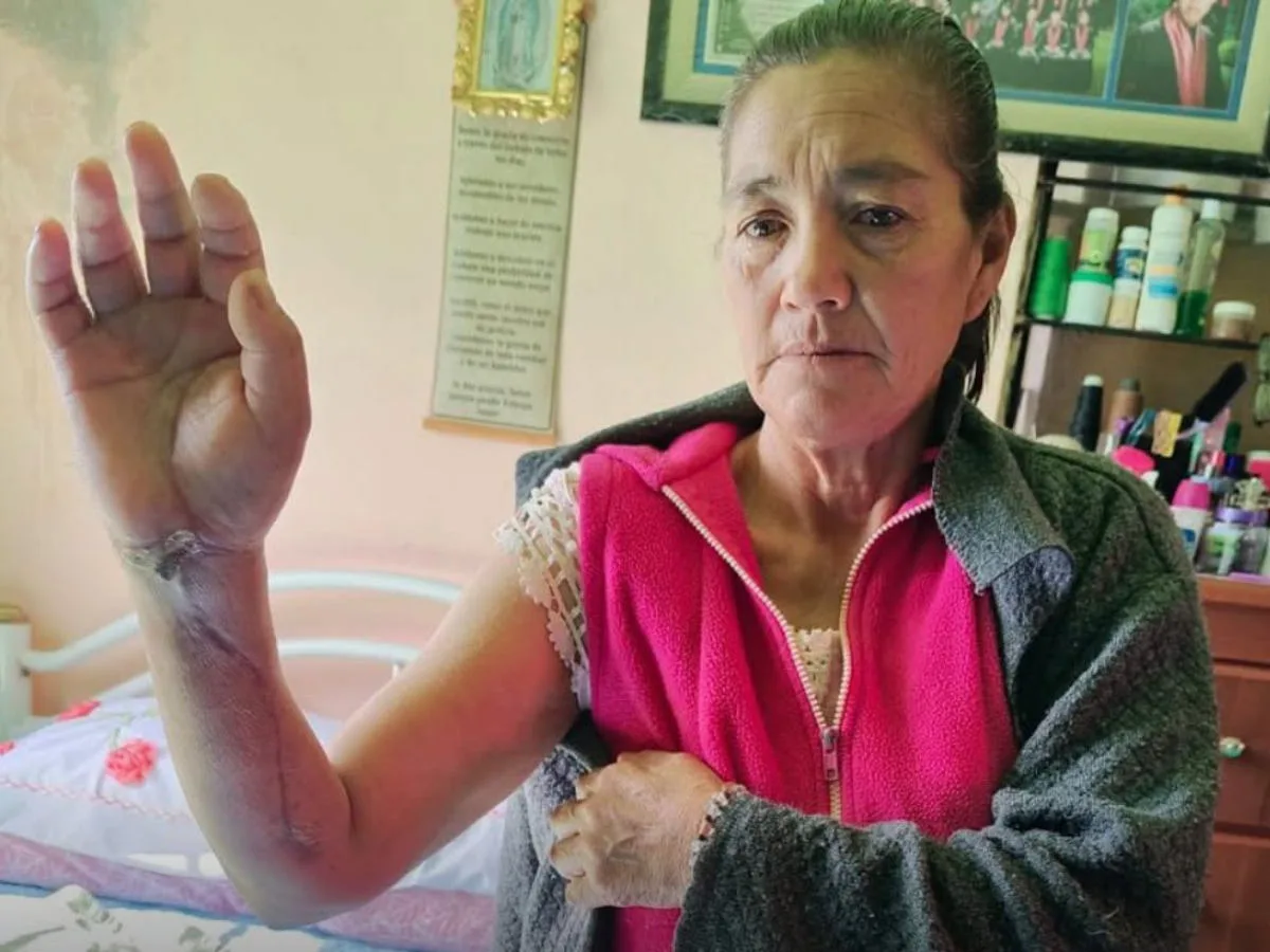 Evitan amputación de brazo a mujer mordida por araña violinista en Hidalgo